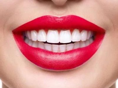 IMPLANTES Dentali roser