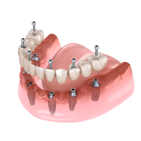 implantes-alicante