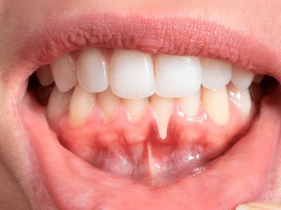 recesion-gingival-alicante